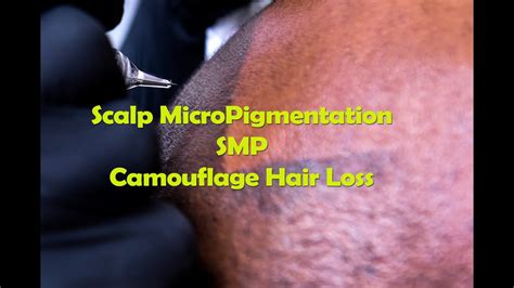 smp bugil|Scalp Micropigmentation in Miami, Florida